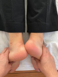 治療院藤森にて骨盤調整の手技をする前の患者様の左右の足の長さです。右側の骨盤がずり上がって短くなっています。