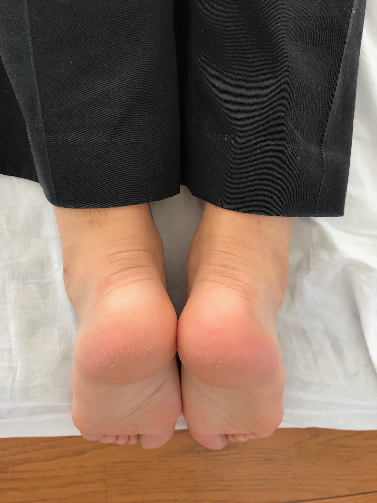 治療院藤森にて骨盤調整手技後の写真です。左右の足の長さが揃っています。